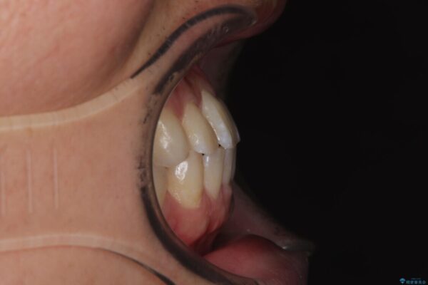 前歯のガタガタ・奥歯のかみ合わせ(シザーズバイト)を改善|1年半で完了したメタルブラケット矯正 治療後画像