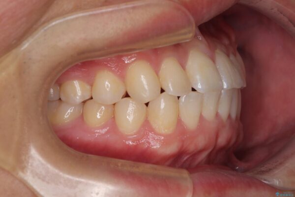 前歯のガタガタ・奥歯のかみ合わせ(シザーズバイト)を改善|1年半で完了したメタルブラケット矯正 治療後画像