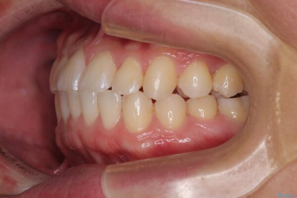 前歯のガタガタ・奥歯のかみ合わせ(シザーズバイト)を改善|1年半で完了したメタルブラケット矯正 治療後画像