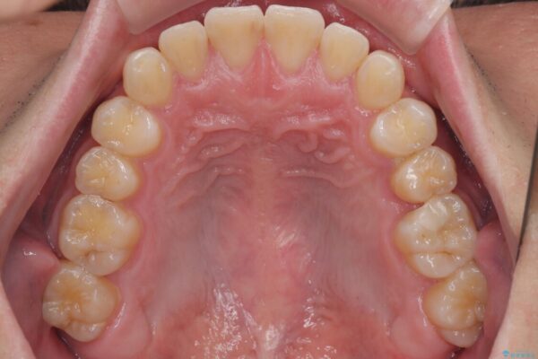 前歯のガタガタ・奥歯のかみ合わせ(シザーズバイト)を改善|1年半で完了したメタルブラケット矯正 治療後画像