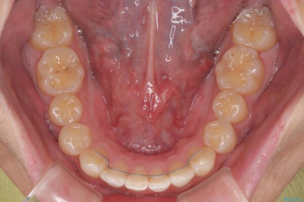 前歯のガタガタ・奥歯のかみ合わせ(シザーズバイト)を改善|1年半で完了したメタルブラケット矯正 治療後画像