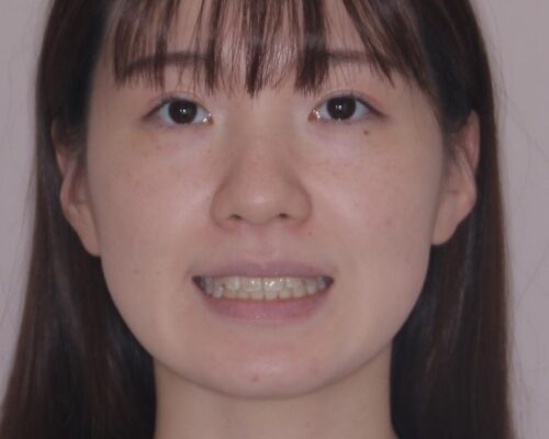 【モニター】前歯のデコボコをスッキリ解消!目立ちにくいワイヤー矯正でスピーディに治療完了 治療後画像