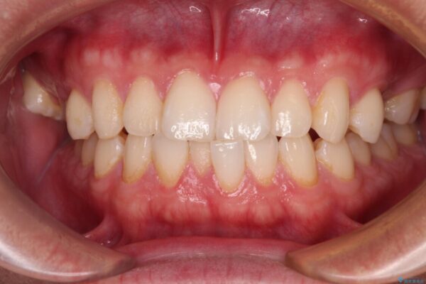 前歯のガタガタ・奥歯のかみ合わせ(シザーズバイト)を改善|1年半で完了したメタルブラケット矯正 ビフォー