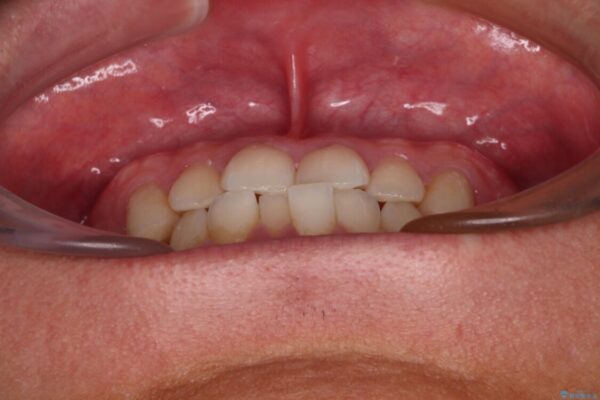 前歯のガタガタ・奥歯のかみ合わせ(シザーズバイト)を改善|1年半で完了したメタルブラケット矯正 治療前画像