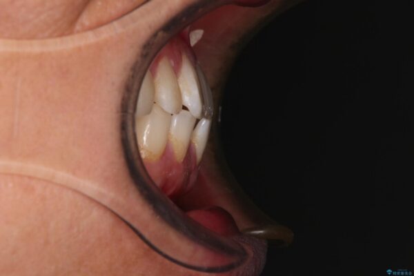 前歯のガタガタ・奥歯のかみ合わせ(シザーズバイト)を改善|1年半で完了したメタルブラケット矯正 治療前画像