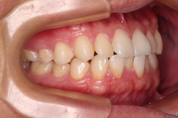 前歯のガタガタ・奥歯のかみ合わせ(シザーズバイト)を改善|1年半で完了したメタルブラケット矯正 治療前画像