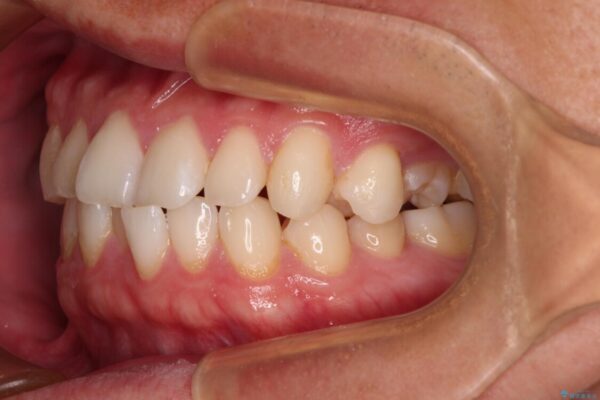 前歯のガタガタ・奥歯のかみ合わせ(シザーズバイト)を改善|1年半で完了したメタルブラケット矯正 治療前画像