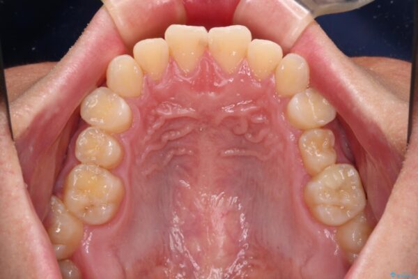 前歯のガタガタ・奥歯のかみ合わせ(シザーズバイト)を改善|1年半で完了したメタルブラケット矯正 治療前画像