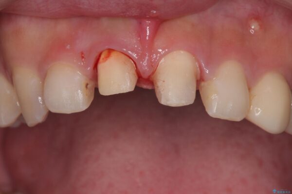 「抜歯してブリッジ」と言われた20代女性が選んだ治療とは|たった4か月で自然な笑顔に抜歯即時インプラント+審美補綴の症例 治療前画像