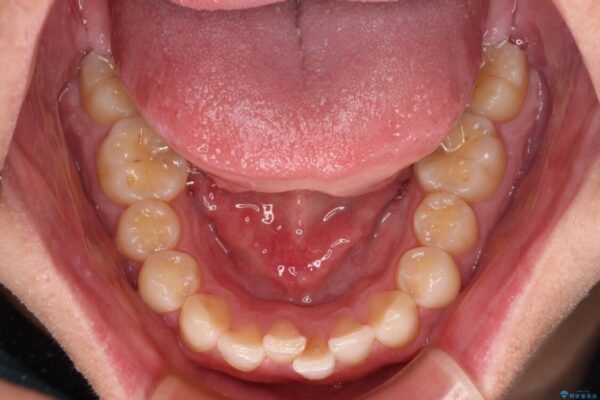 前歯のガタガタ・奥歯のかみ合わせ(シザーズバイト)を改善|1年半で完了したメタルブラケット矯正 治療前画像