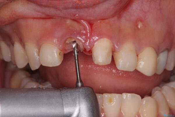 「抜歯してブリッジ」と言われた20代女性が選んだ治療とは|たった4か月で自然な笑顔に抜歯即時インプラント+審美補綴の症例 治療途中画像