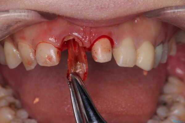 「抜歯してブリッジ」と言われた20代女性が選んだ治療とは|たった4か月で自然な笑顔に抜歯即時インプラント+審美補綴の症例 治療後画像