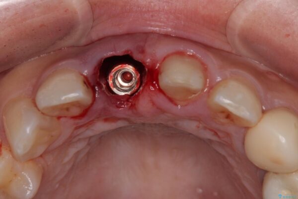 「抜歯してブリッジ」と言われた20代女性が選んだ治療とは|たった4か月で自然な笑顔に抜歯即時インプラント+審美補綴の症例 治療前画像