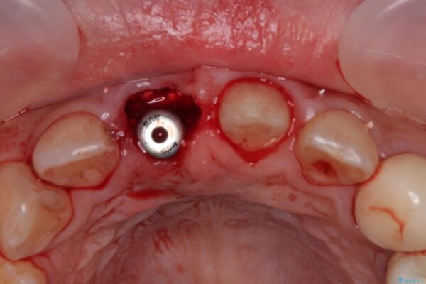 「抜歯してブリッジ」と言われた20代女性が選んだ治療とは|たった4か月で自然な笑顔に抜歯即時インプラント+審美補綴の症例 治療途中画像