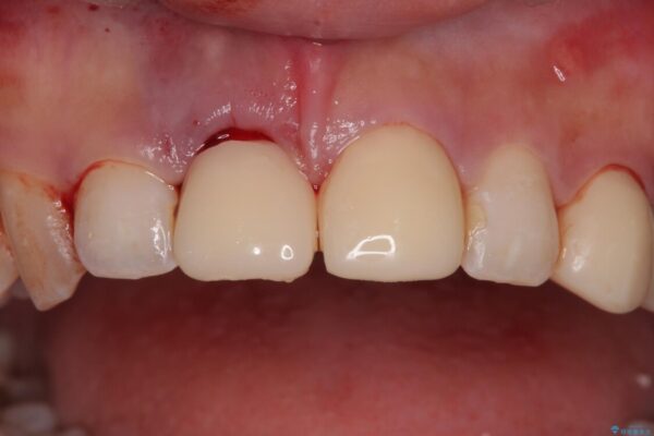 「抜歯してブリッジ」と言われた20代女性が選んだ治療とは|たった4か月で自然な笑顔に抜歯即時インプラント+審美補綴の症例 治療後画像