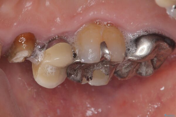 自然な美しさと強度を両立!右上小臼歯の被せもの脱離に対する審美補綴治療 治療前画像