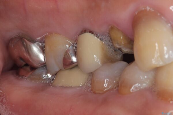 自然な美しさと強度を両立!右上小臼歯の被せもの脱離に対する審美補綴治療 治療前画像