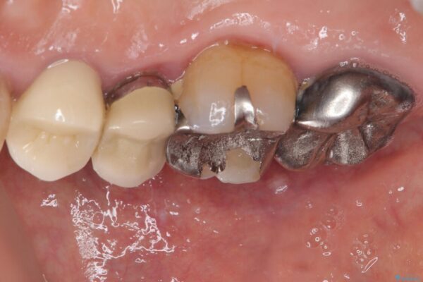 自然な美しさと強度を両立!右上小臼歯の被せもの脱離に対する審美補綴治療 治療後画像