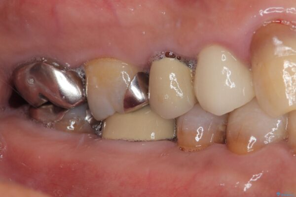 自然な美しさと強度を両立!右上小臼歯の被せもの脱離に対する審美補綴治療 治療後画像