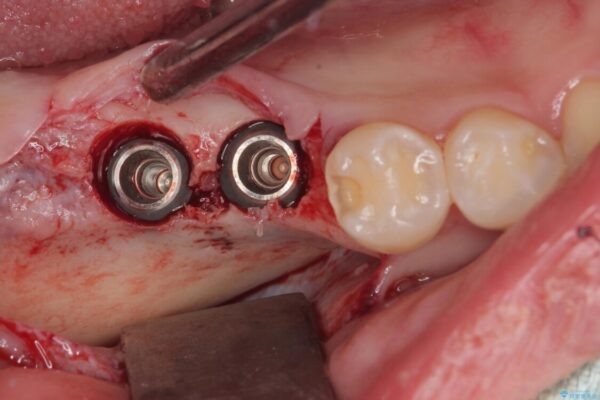 挺出歯を圧下してスペースを確保!目立たない部分矯正で下顎大臼歯にインプラント治療を実現 治療途中画像