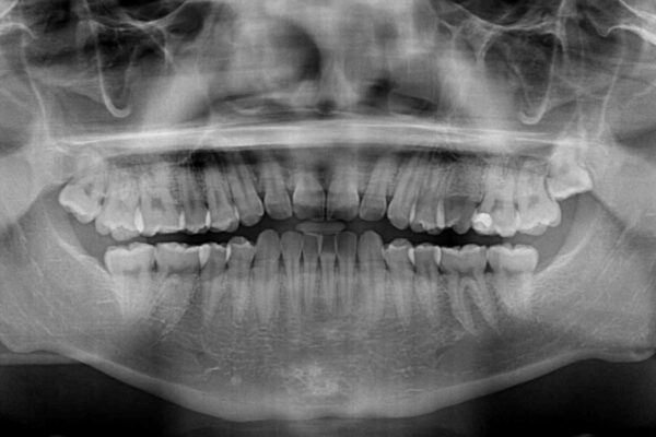 前歯のガタガタ・奥歯のかみ合わせ(シザーズバイト)を改善|1年半で完了したメタルブラケット矯正 治療前画像