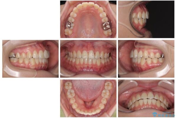 前歯のねじれ・ガタガタを10か月で改善!20代女性の矯正治療|クリアブラケットでむし歯になりにくい歯並びへ改善 治療後画像