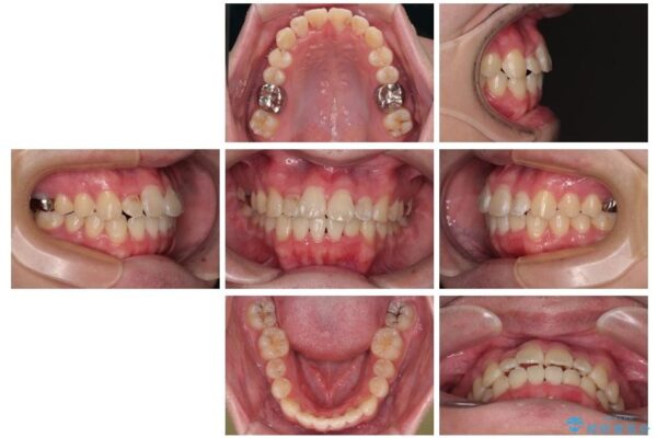 1年でここまで変わる!歯列のがたつきと正中のズレを改善した矯正治療(メタルブラケット×MARPE) 治療後画像