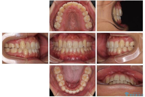 八重歯と前歯のガタガタを抜歯矯正で治療|クリアブラケット使用例 治療後画像