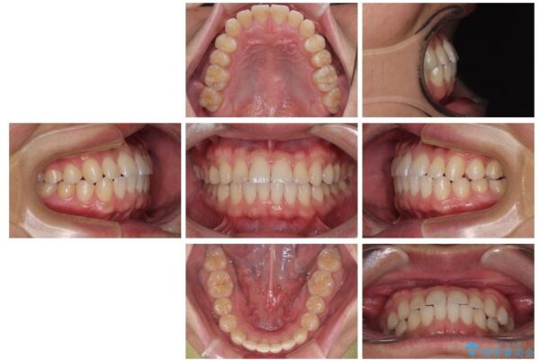 前歯のガタガタ・奥歯のかみ合わせ(シザーズバイト)を改善|1年半で完了したメタルブラケット矯正 治療後画像
