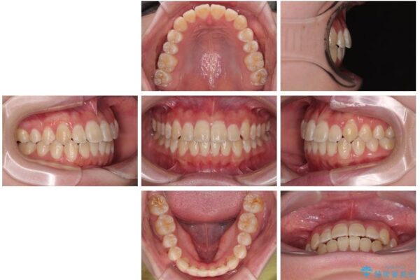 【モニター】前歯のデコボコをスッキリ解消!目立ちにくいワイヤー矯正でスピーディに治療完了 治療後画像