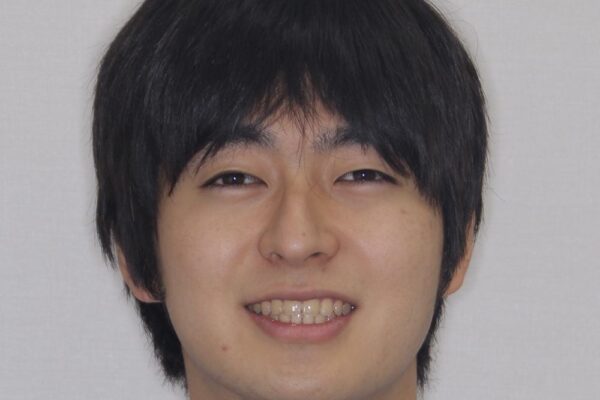 【モニター】飛び出した上の前歯　ワイヤー装置を併用してインビザラインできれいに 治療後画像