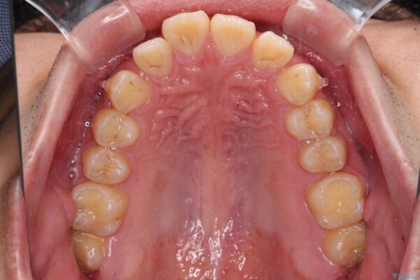 【モニター】飛び出した上の前歯　ワイヤー装置を併用してインビザラインできれいに 治療途中画像